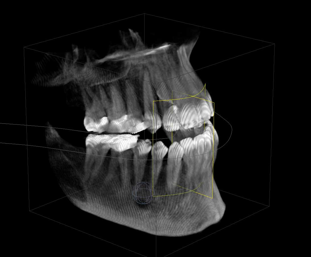3D_Bild von Gebiss